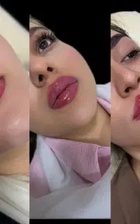تزریق ژل، بوتاکس و جوانسازی پوست صورت