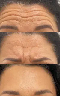 تزریق prp و بوتاکس و جوانساز در کلینیک زیبایی