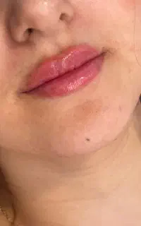 تخفیف ژل بوتاکس،رفع تیرگی،ریمو تتو،درمان لک،هایفو