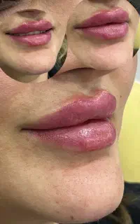 تزریق فیلرلب وگونه و چونه و شیدلب و میکرو