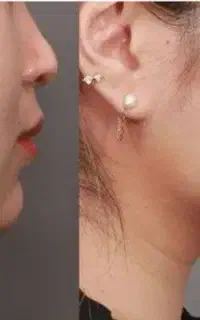 ساکشن غبغب و ژل بوتاکس
