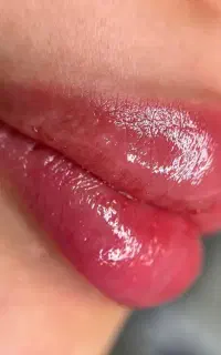 ساکشن چربی و تزریق چربی و تزریق فیلر بادی بدن