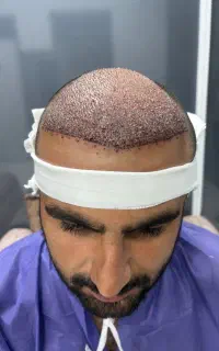 کاشت مو تضمینی گچساران