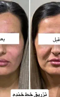 فیلر لب و بوتاکس