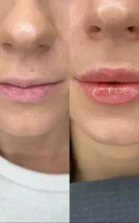 ژل بوتاکس فیلر زیبایی درمانی توسط پزشک