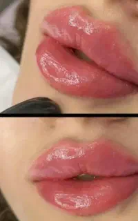 تزریق ژل و بوتاکس ومزو  درکلینیک