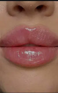 ژل فیلر بوتاکس مزو جوانسازی و ابرو