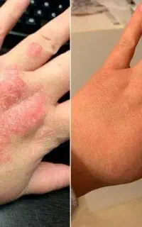 بهبود پسوریازیس و پیسی