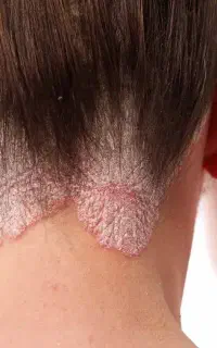 بهبود کامل و ریشه ای پسوریازیس