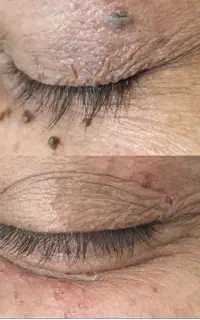 برداشتن خال و زگیل در یک جلسه