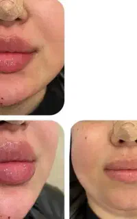 جشنواره بوتاکس زیربغل،ژل بوتاکس فیلربادی مزورایگان