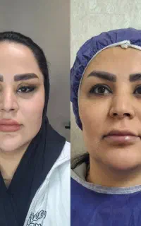 جراحی افتادگی پلک فقط ۷.۹۹۰ تومن