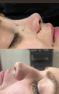 جراحی زیبایی بینی ۲۰الا۲۳ولیفت وساکشن دراهواز