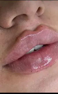 تخفیفات ویژه خدمات زیبایی ژل و بوتاکس