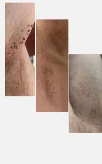 حذف زائده زگیل