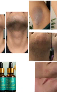 رفع دائم موهای زائد بدون لیزر (پرداخت درب منزل)