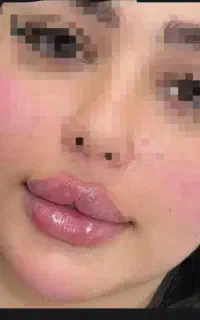تزریق فیلر و بوتاکس