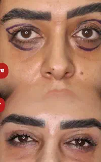 جراحی پلک / لیفت ابرو / لیفت صورت