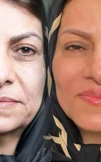 پوست صورتتو حداقل ۵ سال جوان تر کن (مزوژل اختصاصی)
