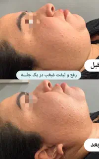 لاغری و لیفت تضمینی