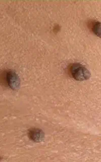 برداشت منگوله پوستی و میلیا