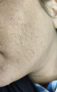 الکترولیز(لیزرنیست)حذف دائم موهای سفیدوسیاه