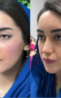 فیلر لب روسی/کانتور و لیفت صورت/لیفت نخ/بوتاکس