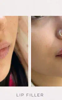 آفر ویژه تزریق فیلر و بوتاکس در تنکابن