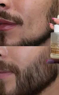 محلول. رویش.ریش.سبیل .۲۶ روزه