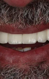 دندانپزشکی حرفه ای‌ ایمپلنت تخصصی با اقساط طولانی