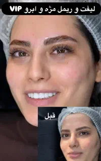 ۲۰ درصد تخفیف لیفت مژه و ابرو