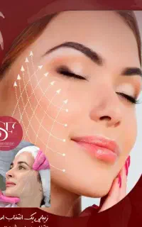لیفت صورت با نخ (اقساط) در کرمان