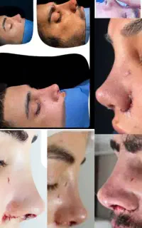 جراحی بینی فقط ۳۰ میلیون