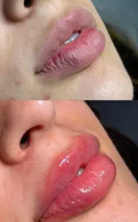 آموزش فیلر و بوتاکس و مزوژل