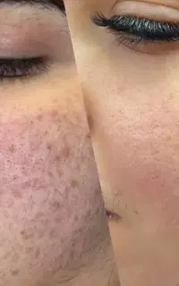 بوتاکس در منزل شما ،پاکسازی،برداشت خال و لک
