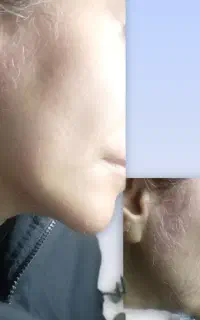 الکترولیز موهای سفید و سیاه