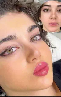 جشنواره تخفیف ۱۰درصدی فیلر ( ژل )