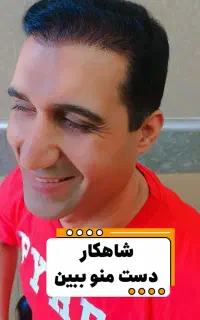 کاشت مو شیرازی