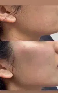 ژل وبوتاکس،پی آر پی،مزو تراپی،پلاسما
