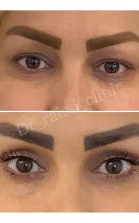 مرکز تخصصی بلفاروپلاستی،لیفت شقیقه و لیفت ابرو