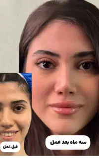 بمب تخفیف جراحی زیبایی بینی پلک و صورت