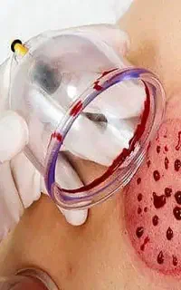 انجام خدمات طب سنتی حجامت ، بادکش و تزریقات