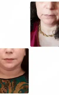 چاقی صورت