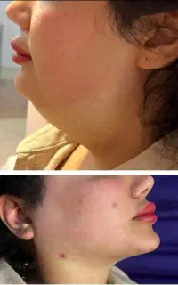 ساکشن پیکرتراشی