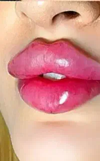 پزشک ژل مزو بوتاکس لب گونه زاویه فیلر prp آنزیم
