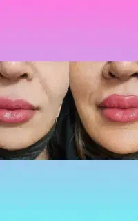 تزریق ژل بوتاکس جوانسازی پی آر پی کربوکسی و لاغری