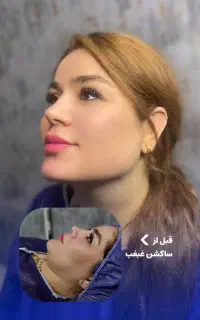 ساکشن غبغب