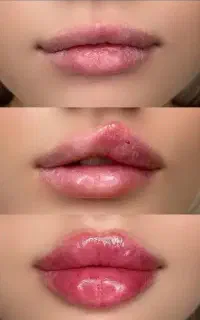 ژل/بوتاکس/آنزیم/مزو فقط ۴۰۰
