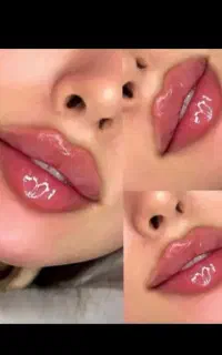 فیلر بوتاکس ژل پی آرپی آموزش