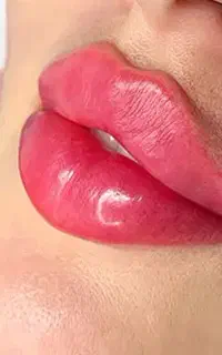 تخفیف فیلرتزریق پزشک/ژل/لب روسی،نخ،بوتاکس وفیلربدن